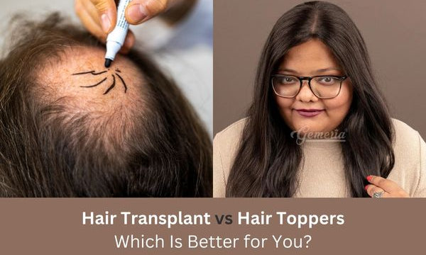 Hair Transplantation vs. Hair Toppers: Save Money and Avoid the Pain