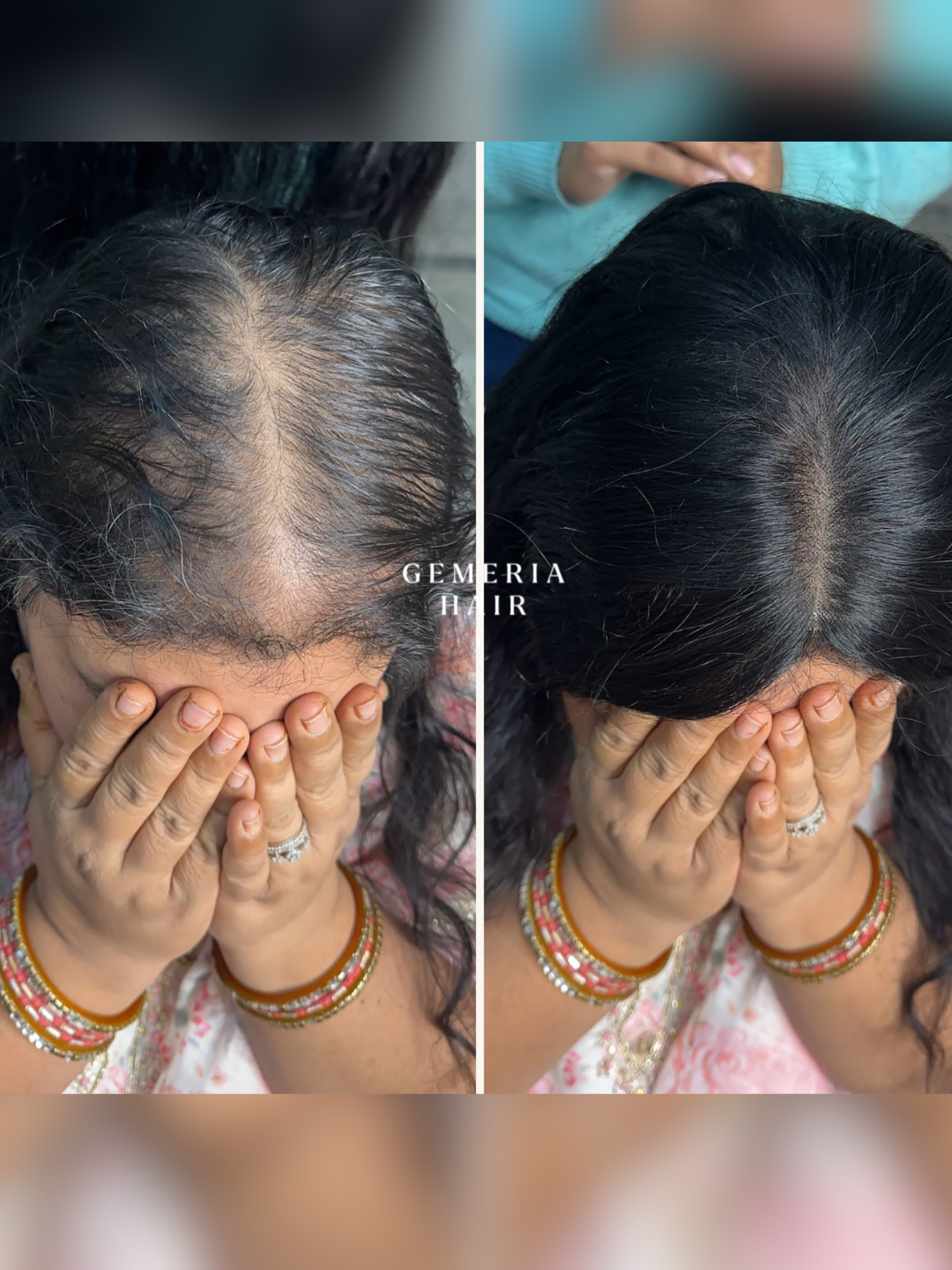 5"x5" | Essential Hair Topper