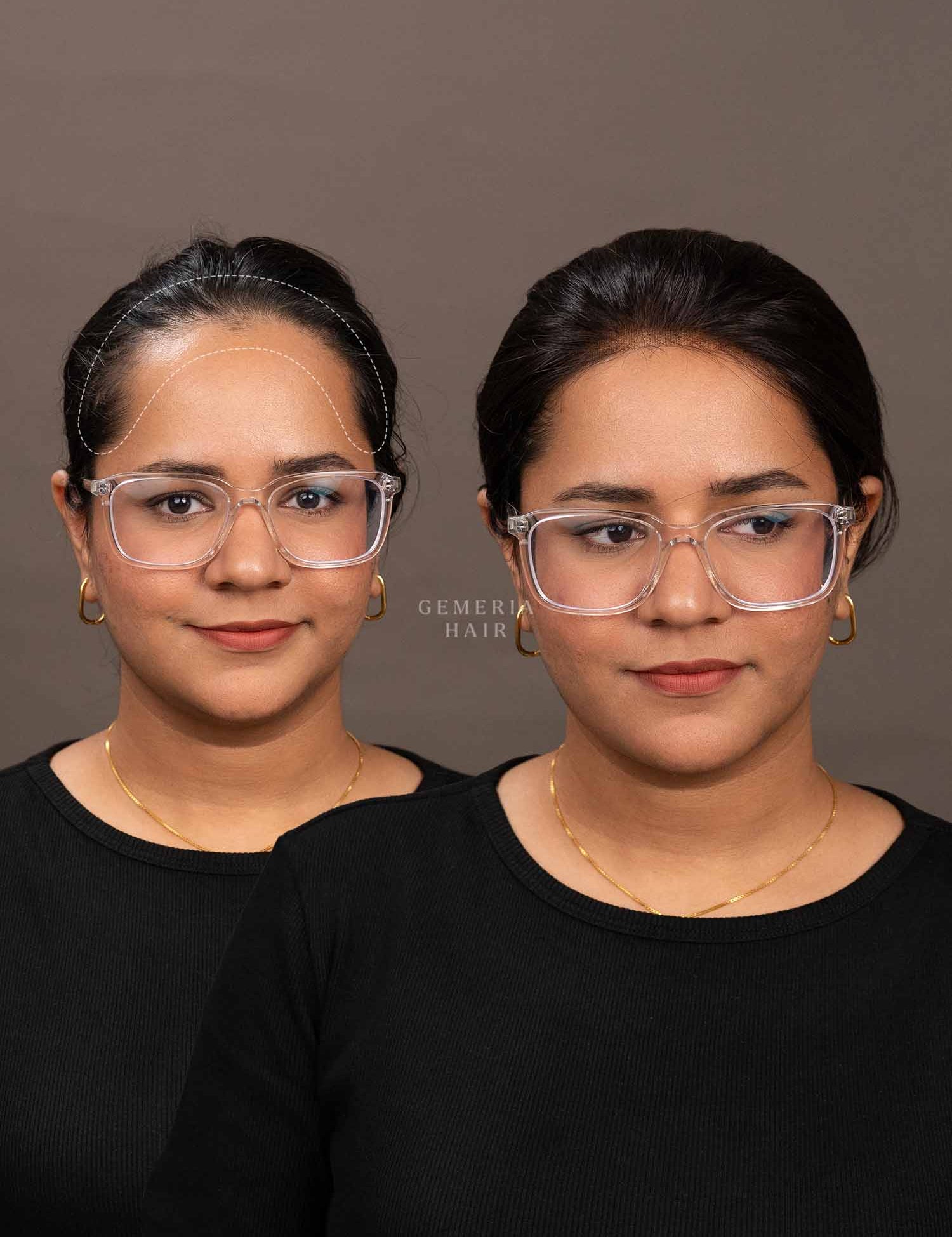 Front hairline topper band creating a natural hairline look