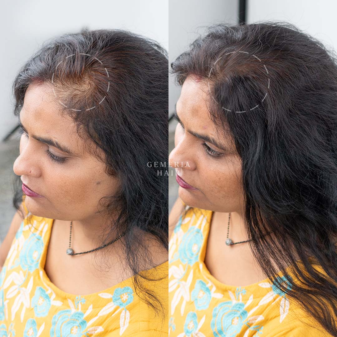 Invisible Spot Cover-Up | 1" Hair Patch