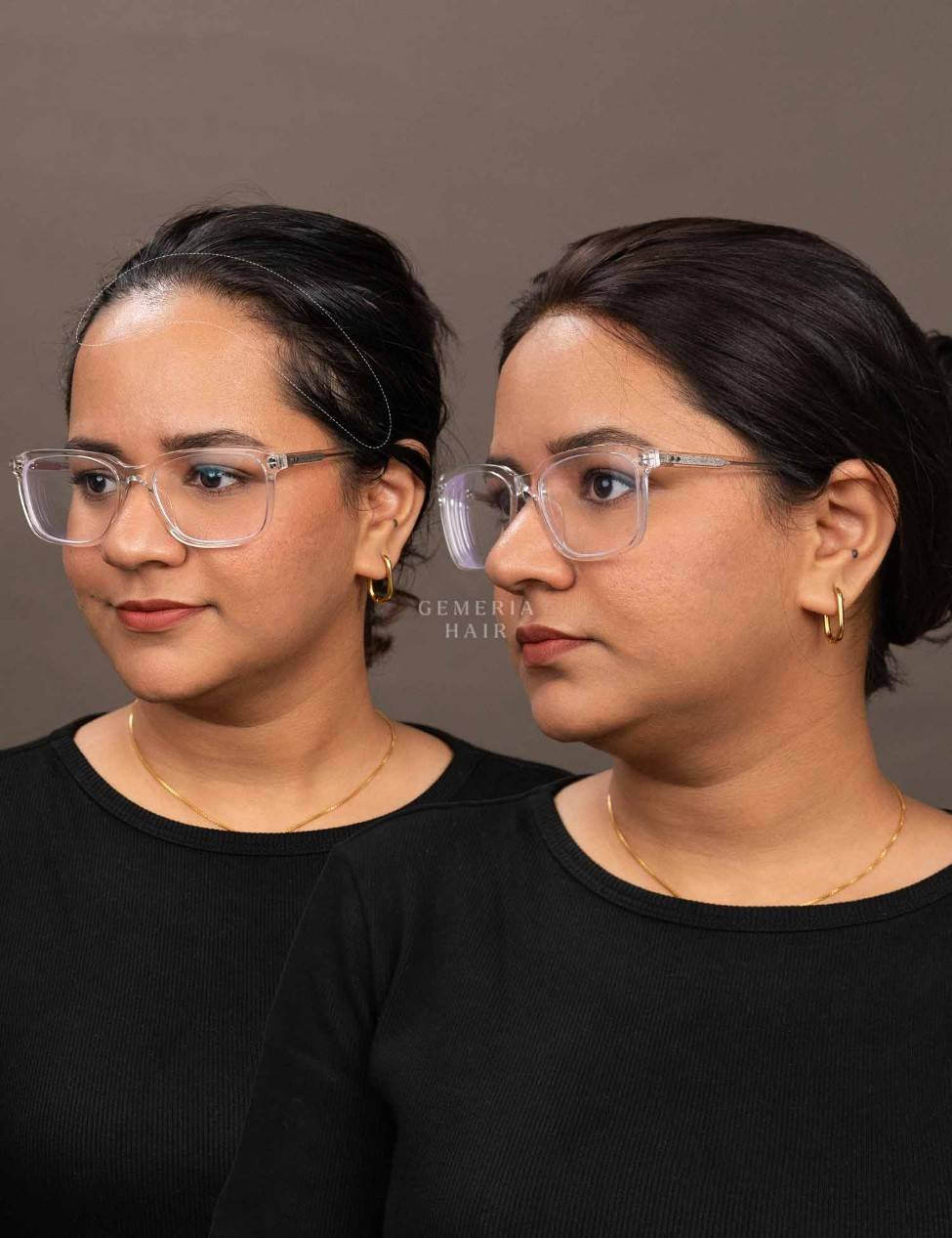Before and after view of women wearing front hairline hair topper